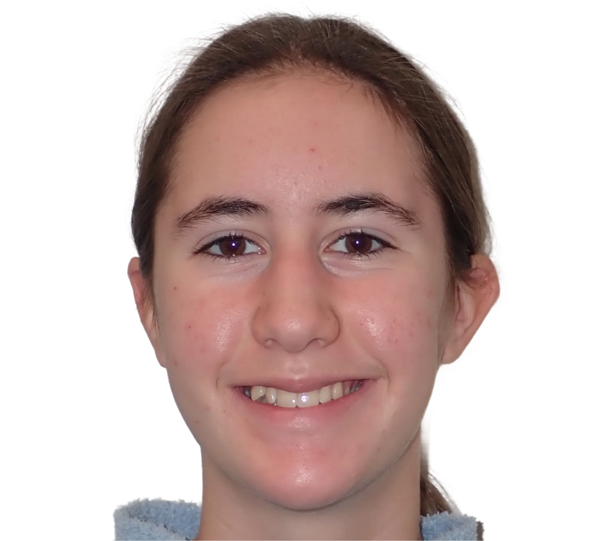 Before orthodontic treatment - Case 60
