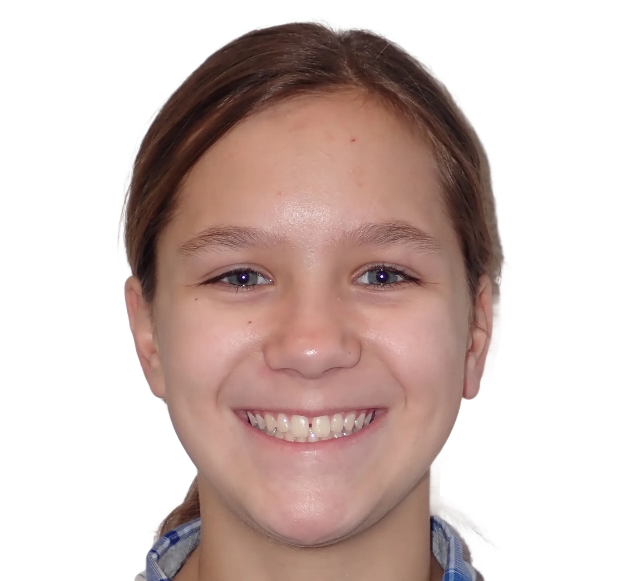 Before orthodontic treatment - Case 61