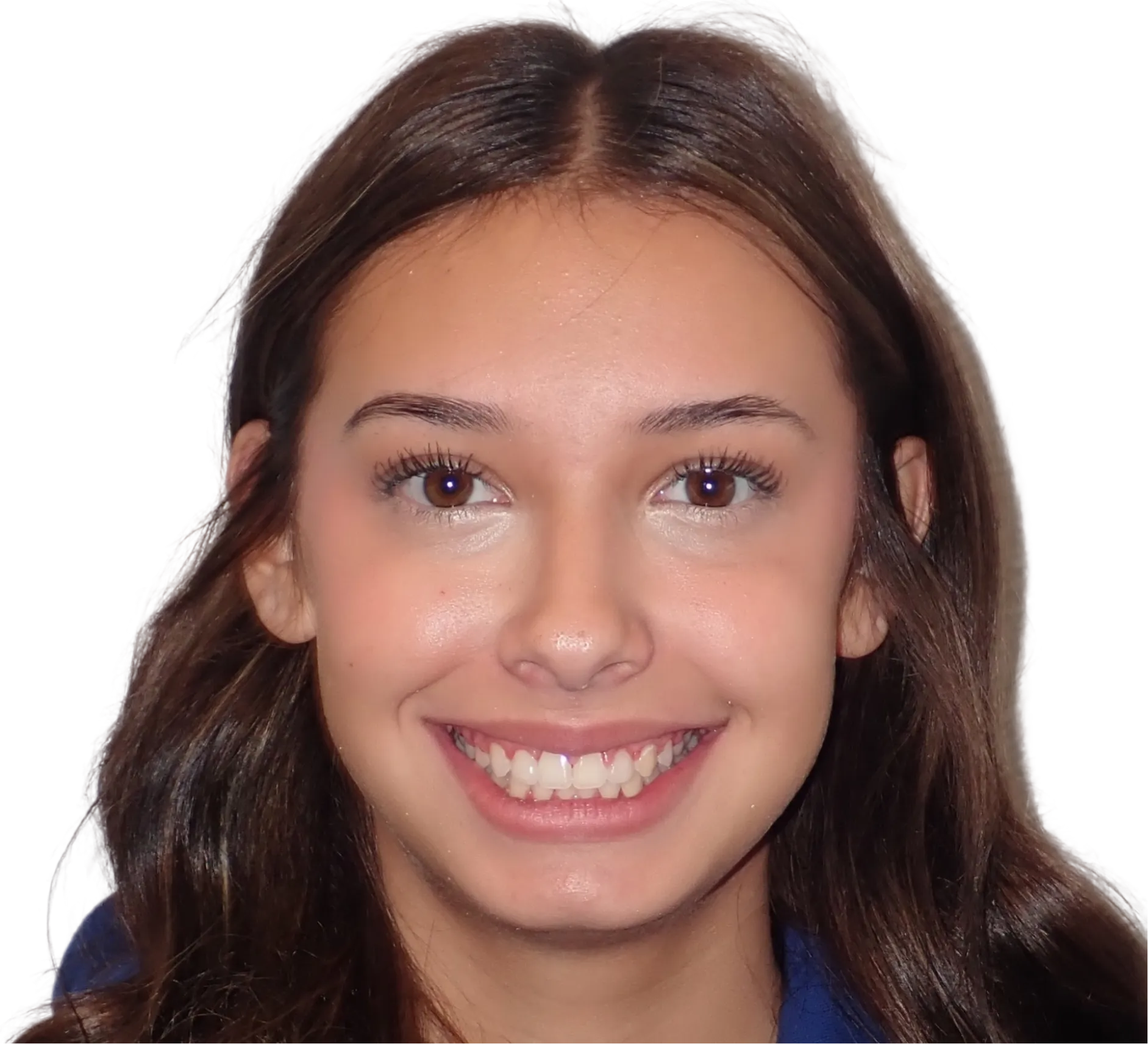 After orthodontic treatment - Case 62