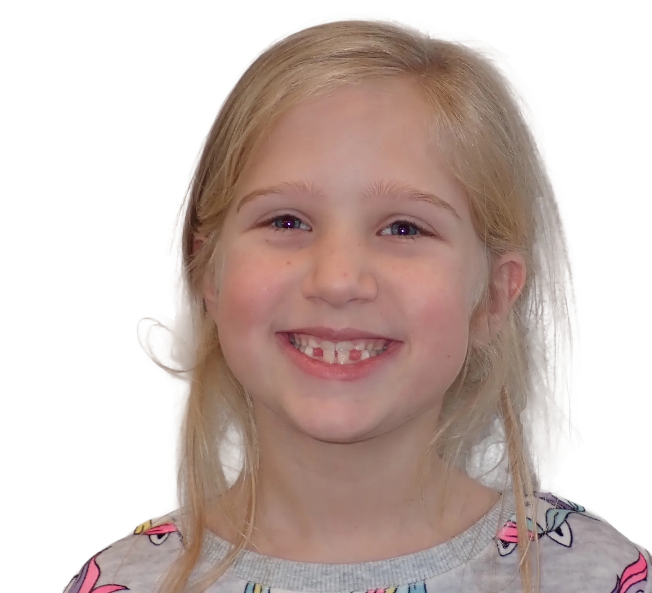 Before orthodontic treatment - Case 63