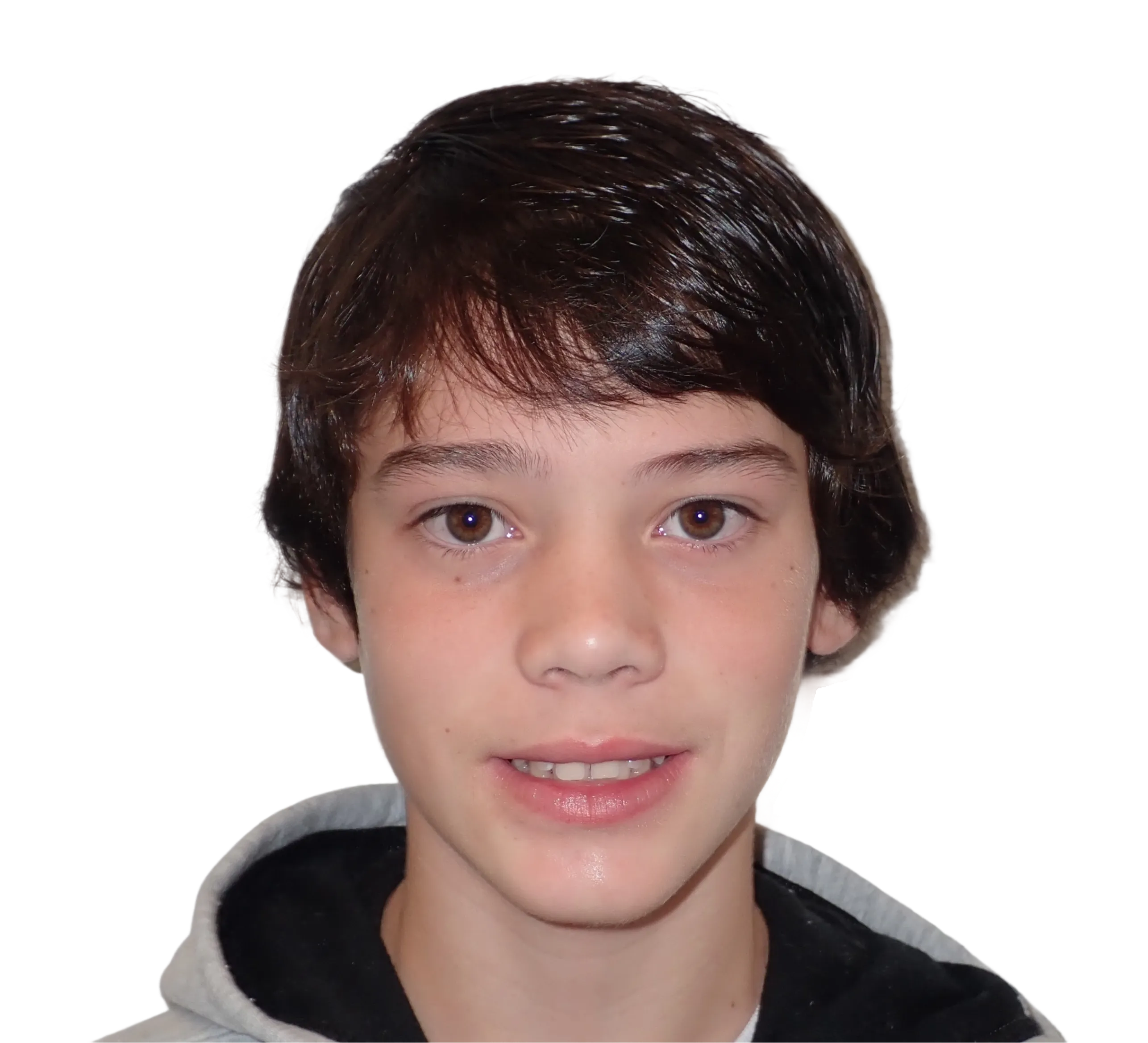 Before orthodontic treatment - Case 15