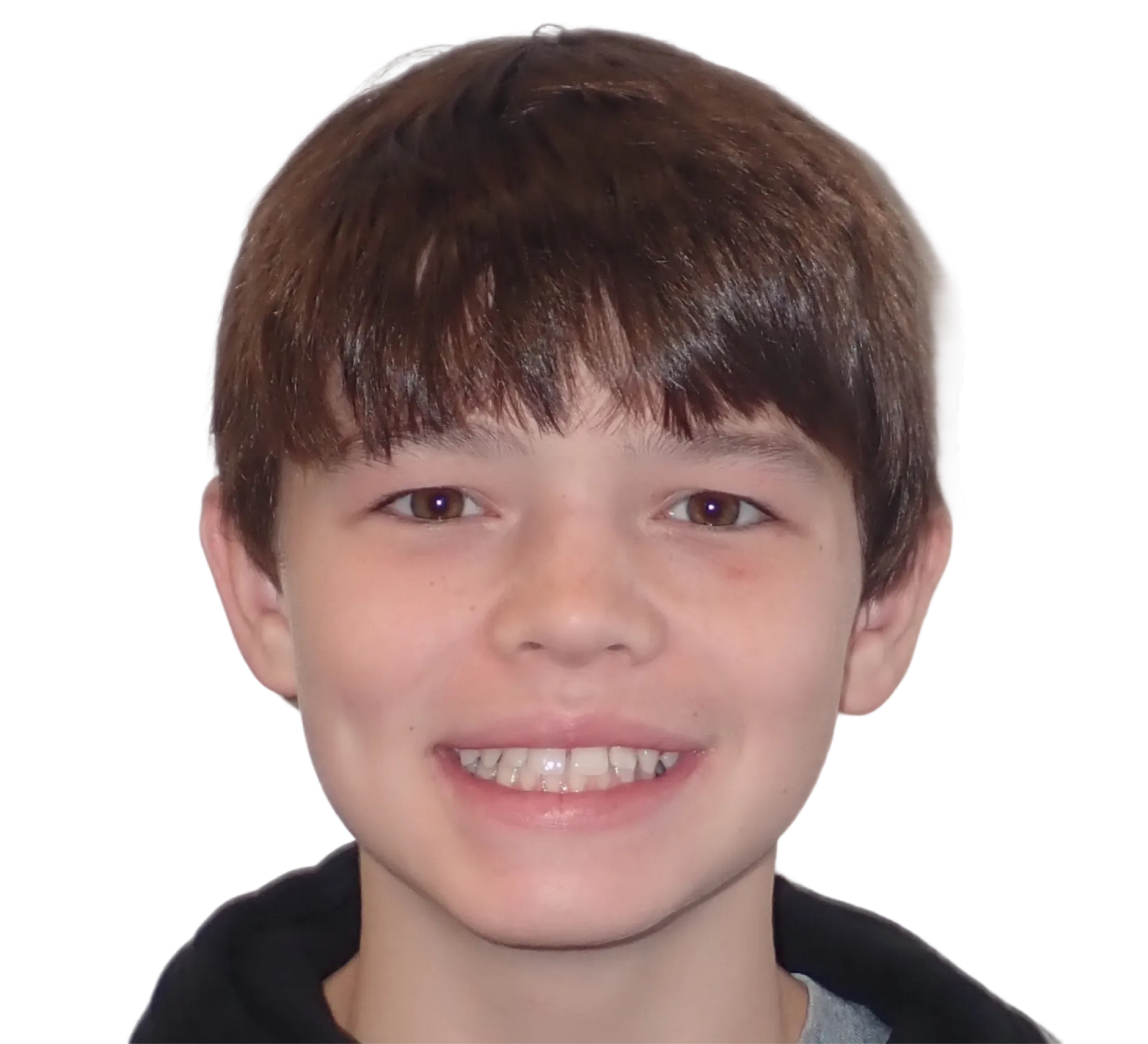 Before orthodontic treatment - Case 16