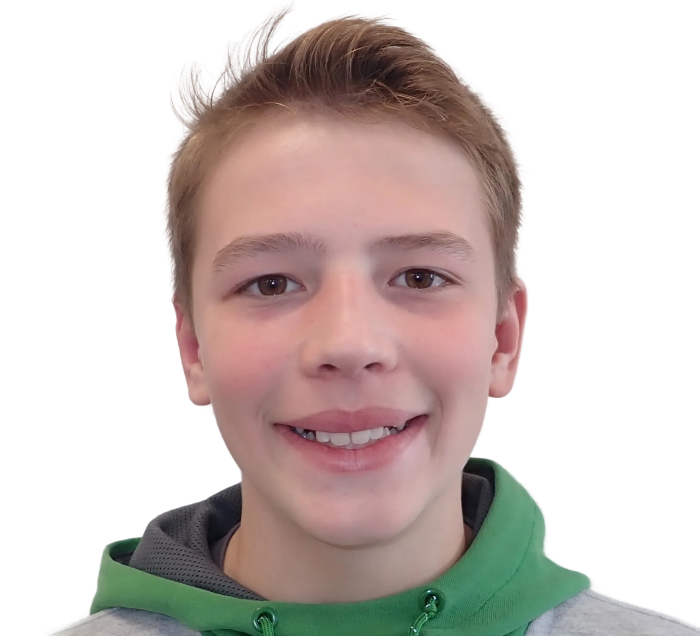 Before orthodontic treatment - Case 17