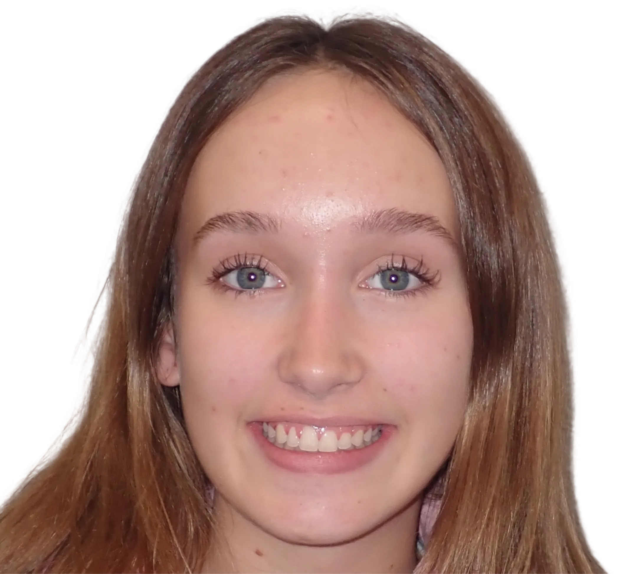 After orthodontic treatment - Case 18