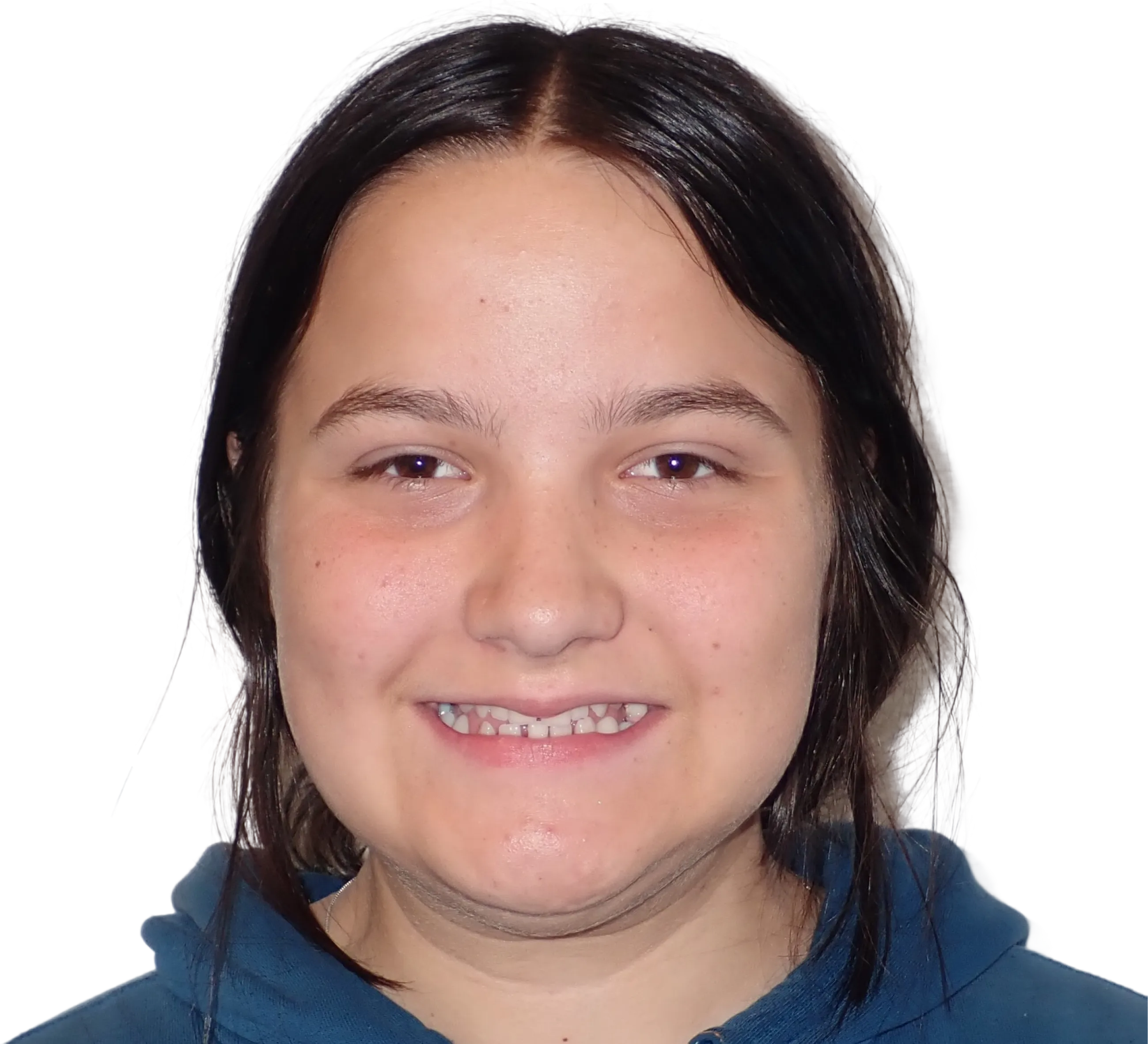 Before orthodontic treatment - Case 19